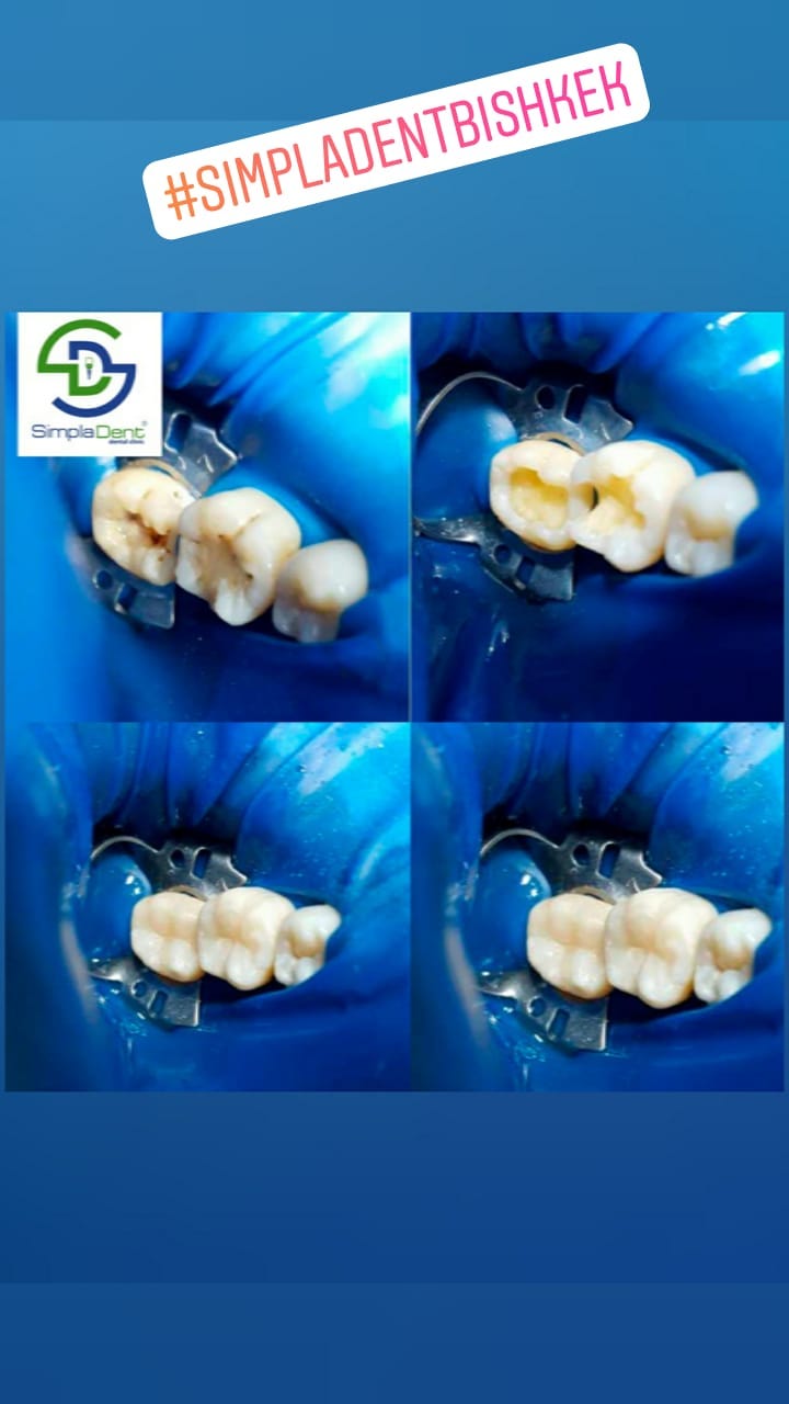 До/После - результат лечения