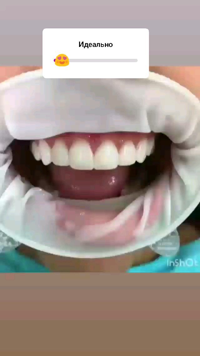 Герметизация фиссур