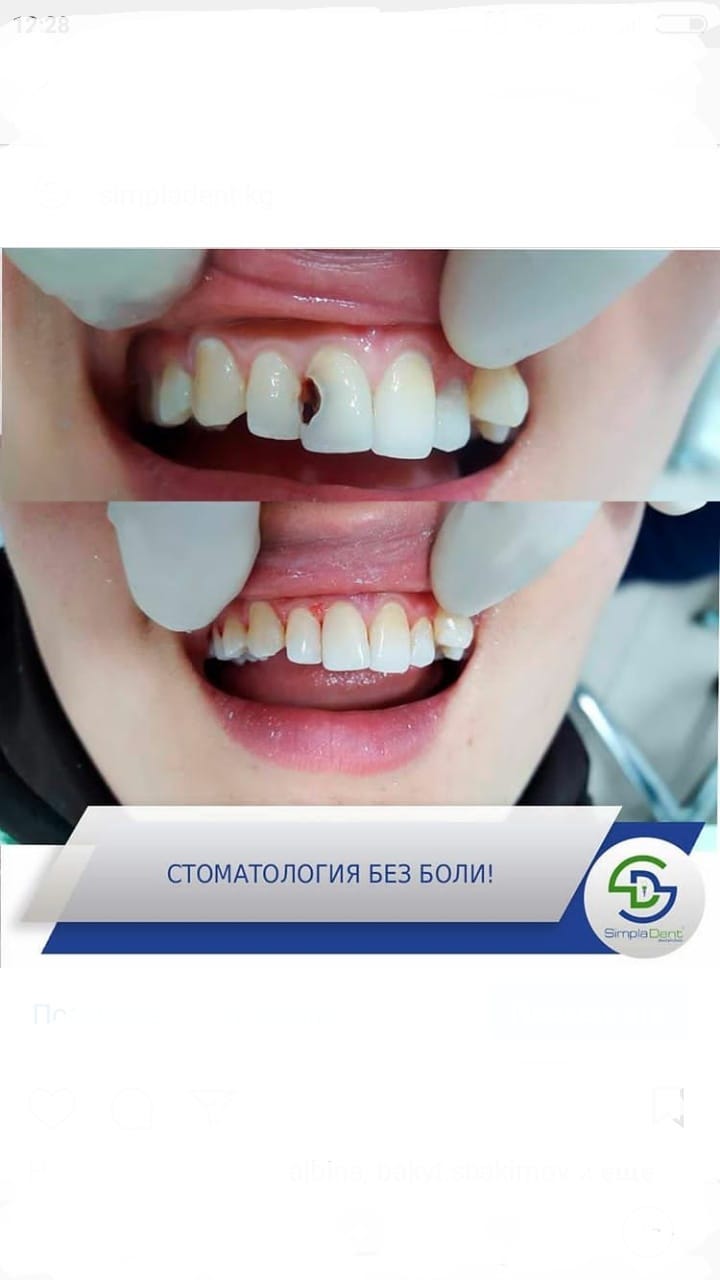 До/После - результат лечения