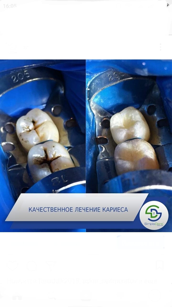 До/После - результат лечения