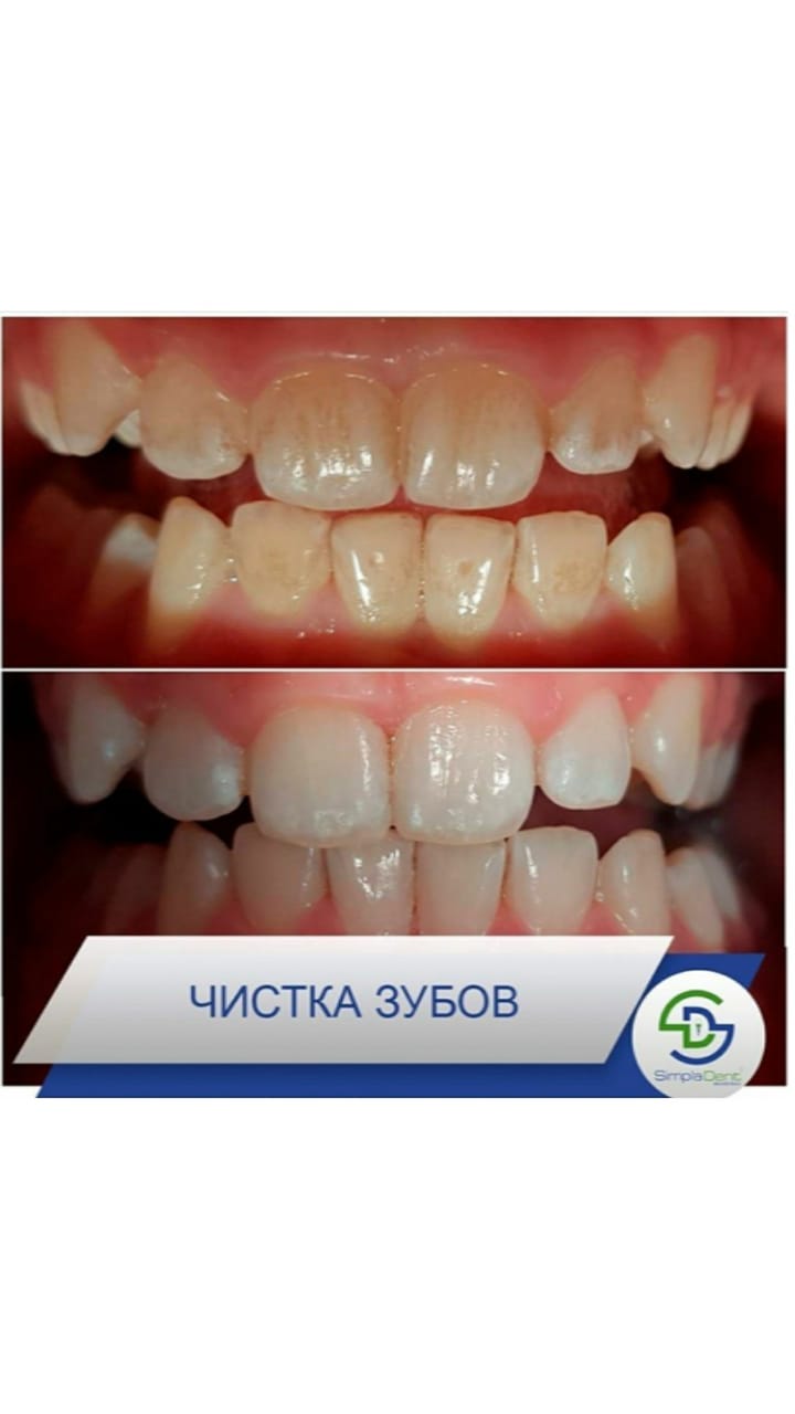 До/После - результат лечения