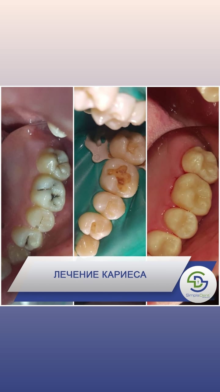 До/После - результат лечения