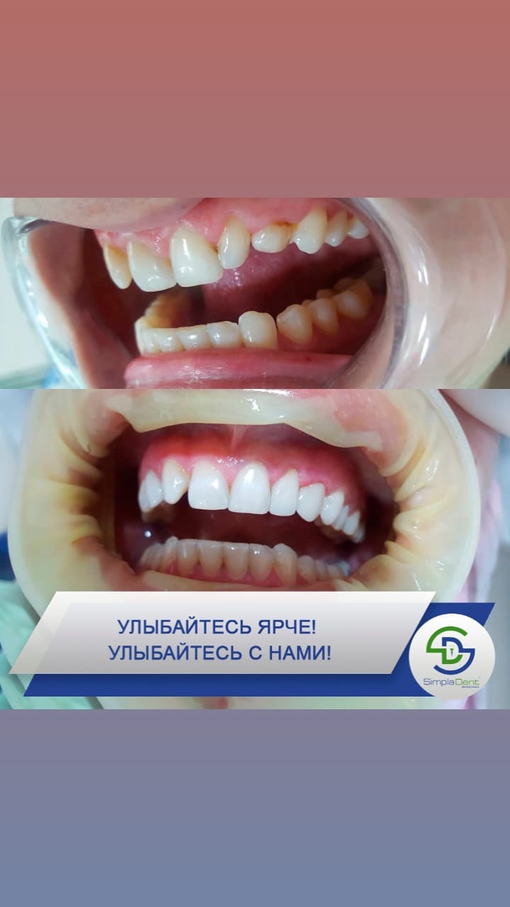 До/После - результат лечения