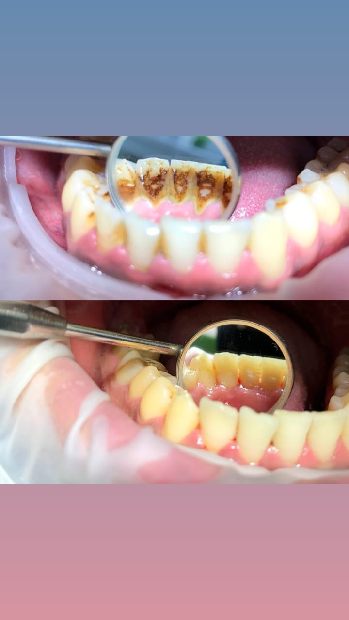 До/После - результат лечения